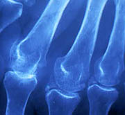 Algodystrophie du Sportif