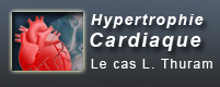 Hypertrophie cardiaque : le cas Lilian Thuram