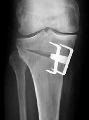 Arthrose et sport : de la hanche au genou.