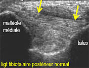 Apport de l'�chographie en pathologie tendino-ligamentaire de la cheville