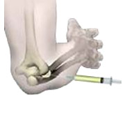 cortisone et glucocortico�des chez le sportif