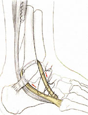 Entorses de cheville : ligamentoplastie de Castaing