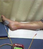 Rupture du tendon d'Achille