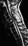 Rachis cervical