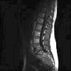 Rachis lombo-sacr�
