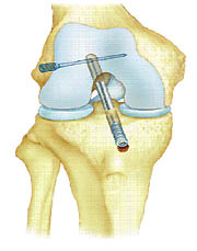 Ligamentoplastie DIDT sous arthroscopie et r��ducation