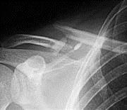 comment soulager fracture clavicule