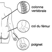 osteoporose