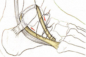 Ligamentoplastie de Castaing