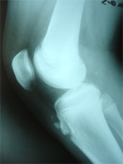 Imagerie médicale : maladie d'Osgood Schlatter, fragment libre.