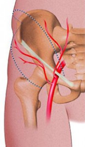 Endofibrose iliaque Endofibrose iliaque