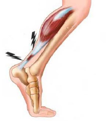 Tendinite et tendinopathie : causes, symptômes et ostéopathie