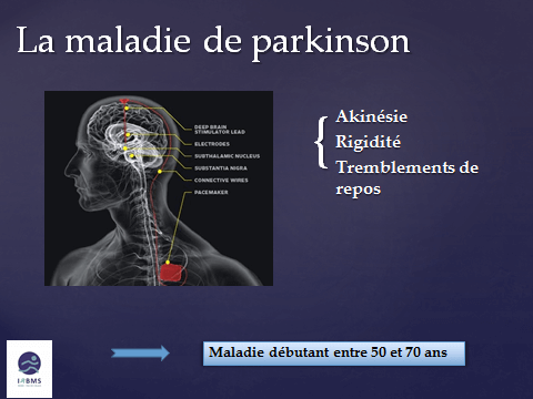 Parkinson : maladie débutant entre 50 et 70 ans