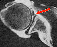 Arthroscanner de l'épaule : lésion de Bankart