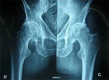 Radiographie des hanches et du bassin