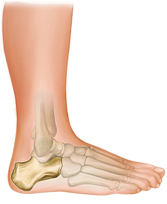 Le calcaneum, cible de la Maladie de Sever