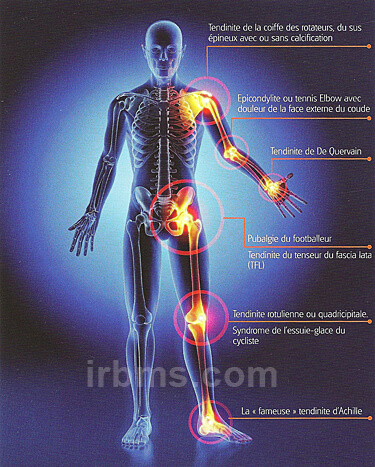 Tendinites : 16 diagnostics fréquents observés en médecine du sport