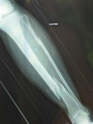 Fracture de la jambe