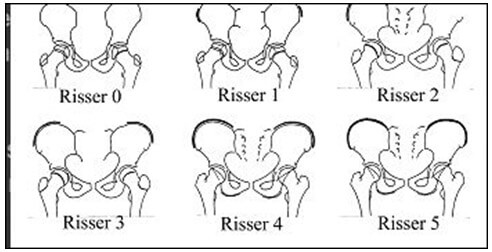 Test de Risser : Classification