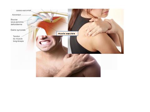 Conduite à tenir devant un traumatisme de l'épaule | IRBMS