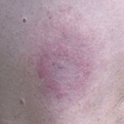 Piq re De Tique Et Maladie De Lyme borr liose IRBMS piq-re-de-tique-et-maladie-de-lyme-borr-liose-irbms