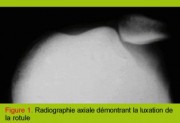 Luxation complète de la rotule