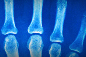 Algodystrophie et sport Algodystrophie et sport
