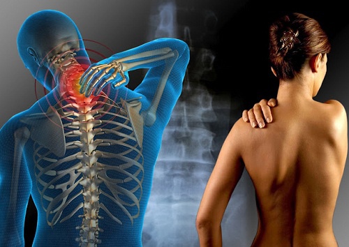 Fibromyalgie et sport