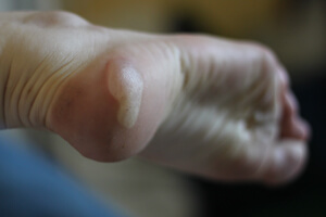 Phlyctenes Aux Pieds Ampoules Traitement Et Prevention