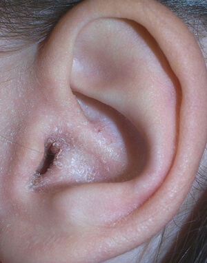 Eczéma de l'oreille Eczéma de l'oreille