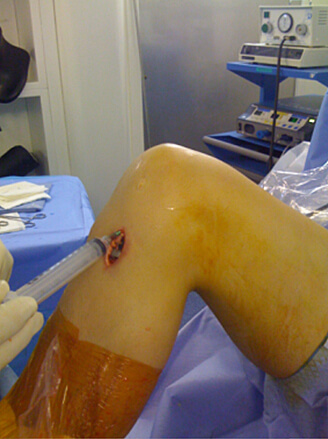 Injection de PRP dans le genou