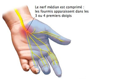 Canal carpien, dépister le syndrome : diagnostic et traitement | IRBMS