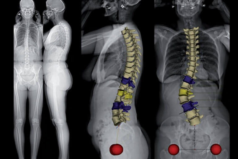 Scoliose dépistage, examen clinique et diagnostic radiologique — free download