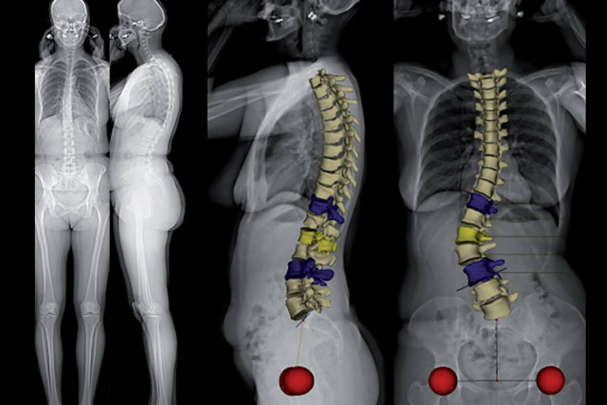 Scoliose : dépistage, examen clinique et diagnostic radiologique