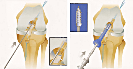 Fixation du transplant