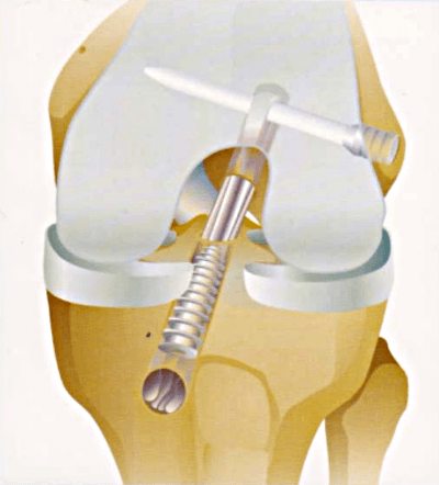 Fixation tibiale par une vis et aspect final