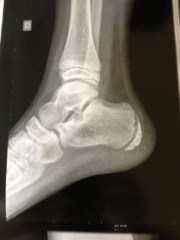 Radio : anomalies osseuses du pied