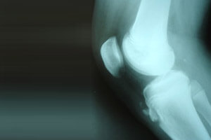 Radiographie genou : osgood-schlatter