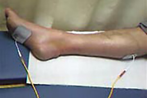 Rééducation après une rupture du tendon d'Achille Rééducation après une rupture du tendon d'Achille