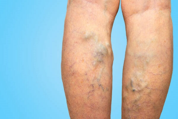 Varices : choisir son sport