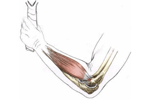 Tennis elbow ou tendinite du coude ou épicondylite