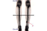 Imagerie médicale : les fractures de fatigue