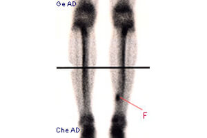 Imagerie médicale : les fractures de fatigue