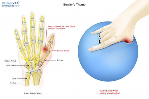 Bowling : Bowler’s Thumb - source : Rehab my patient.com