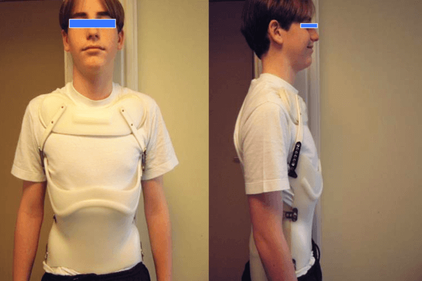 Epiphysite de Scheuermann : traitement par corset