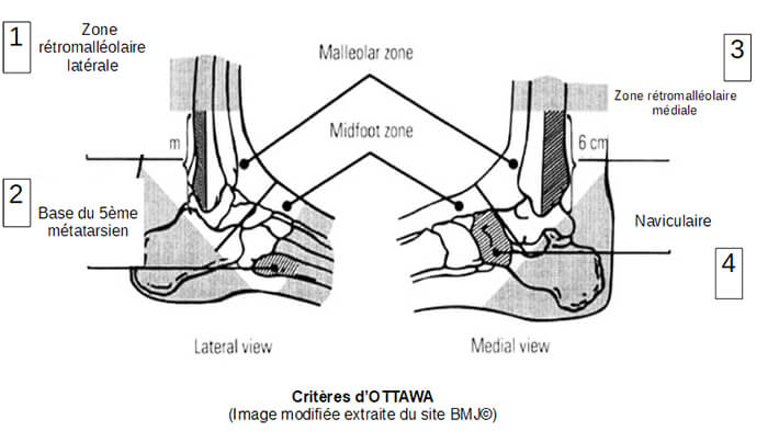 Entorse de cheville : critères d'Ottawa