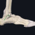 Faisceaux antérieur (LTFA) et moyen (LCF) du ligament collatéral latéral