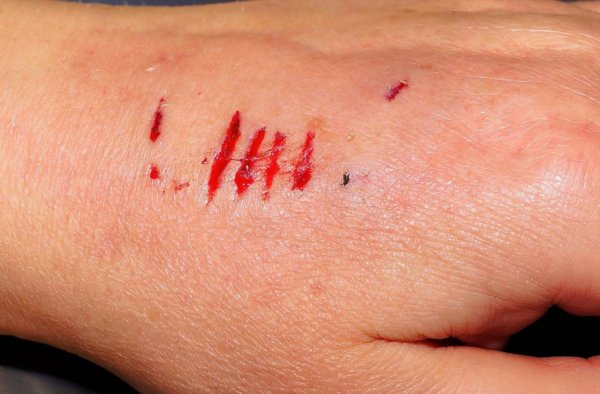 Désinfecter une plaie ou une blessure : quel antiseptique choisir ?