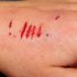 Blessure, plaie : comment la désinfecter ?