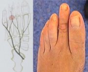 Morton syndrome